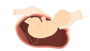 C-section