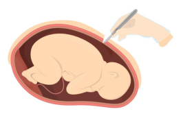 Cesarean Delivery