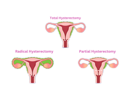 Hysterectomy